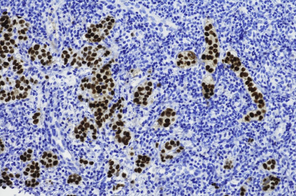 The Biophysical Mechanics of Metastasis