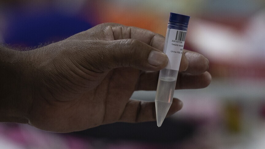 Measles Outbreak Statistics and Hospital Impact