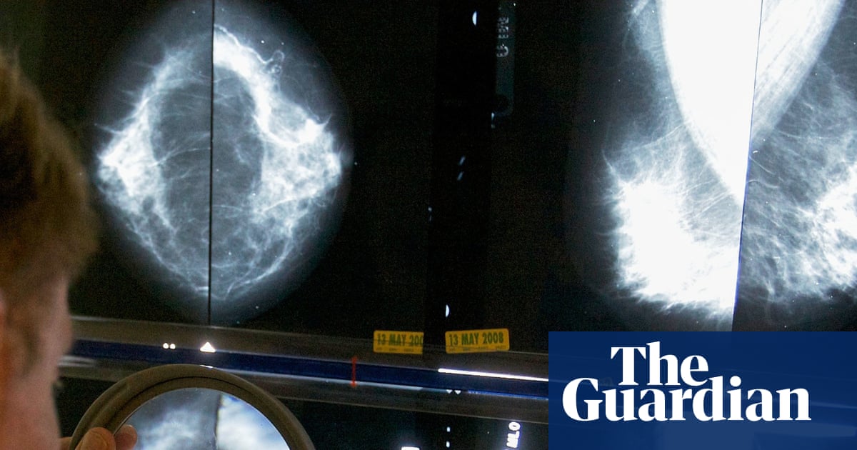 NHS Guidelines for Under-50 Breast Cancer Miss Most At-Risk Women